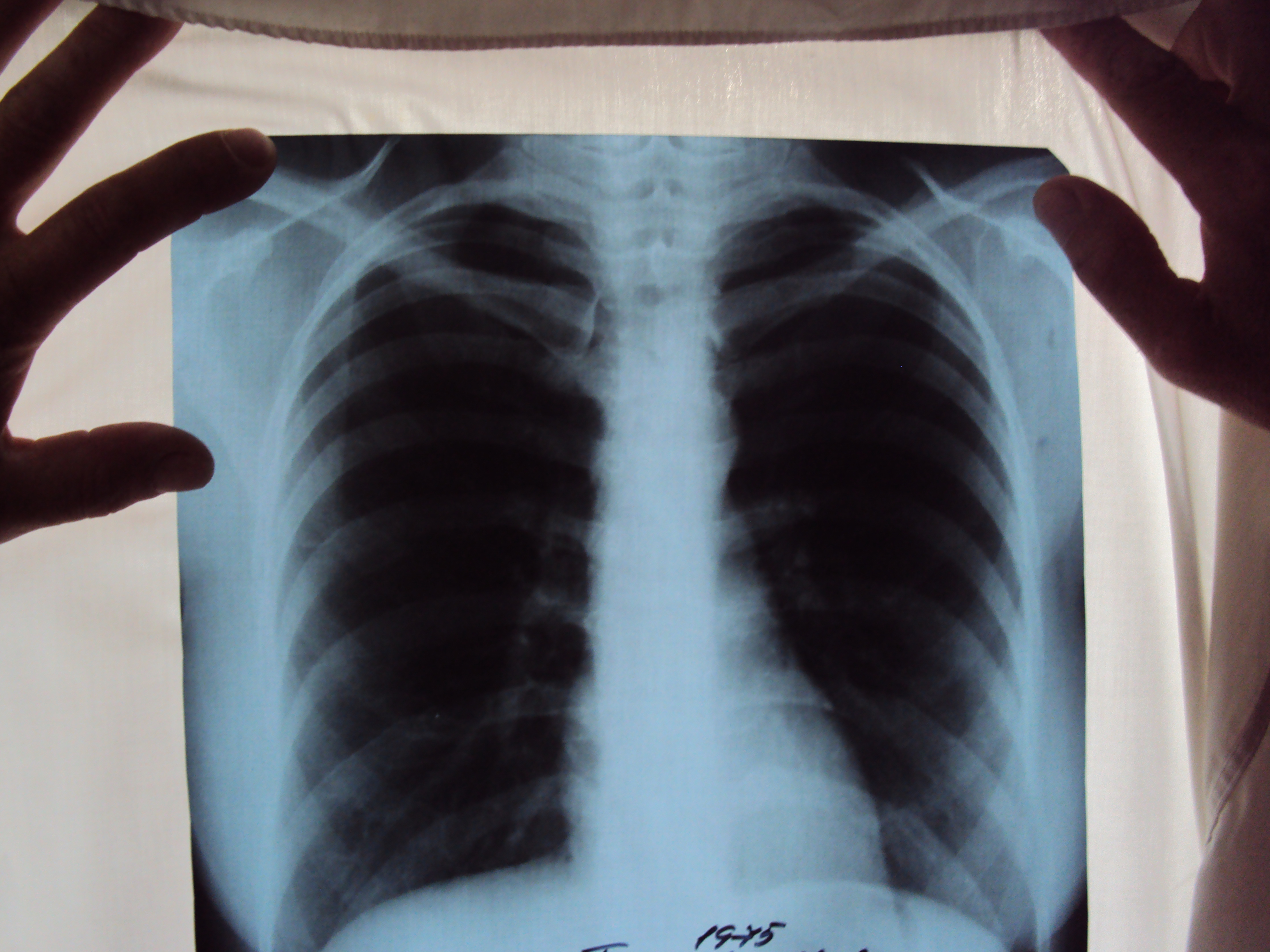 Рентген снимок легких